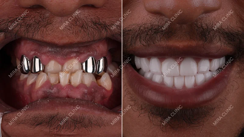 Before and After Dental implants